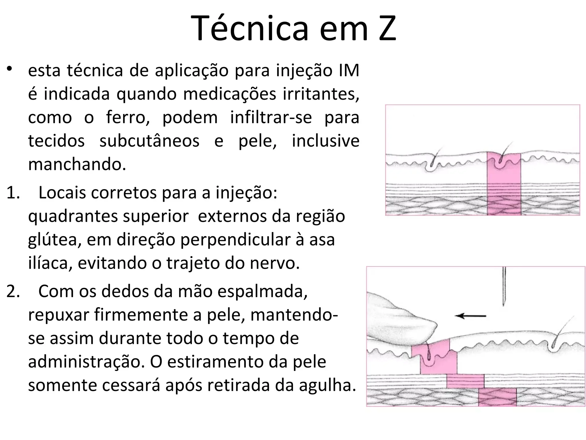 Z-Track Passo 3: Selamento